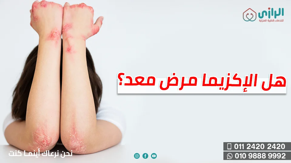 هل-الإكزيما-مرض-معد.webp
