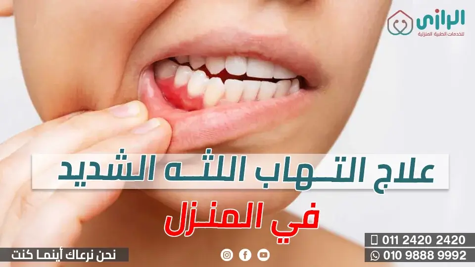 التهاب-اللثه-الشديد.webp