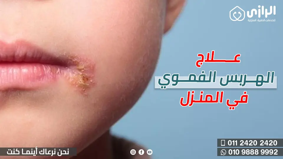 الهربس-الفموي.webp