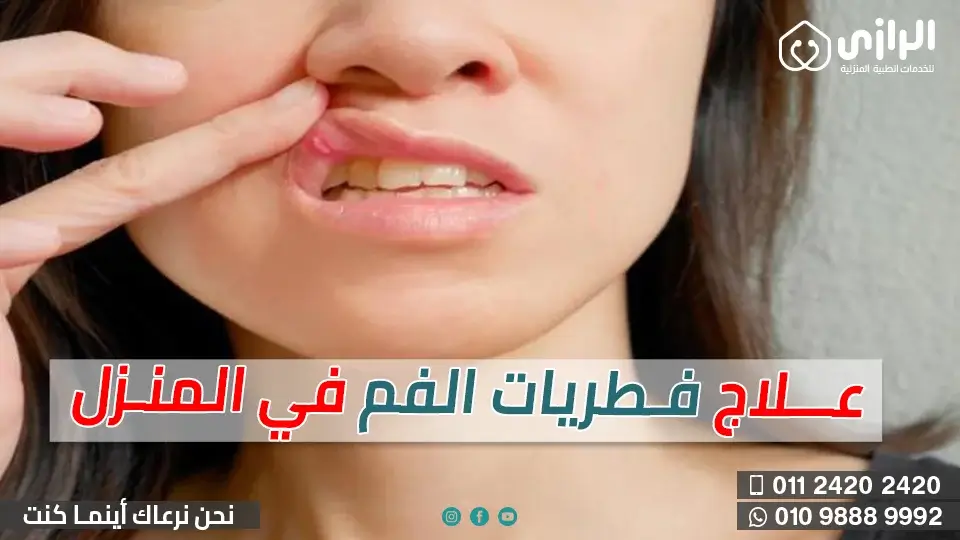 فطريات-الفم.webp