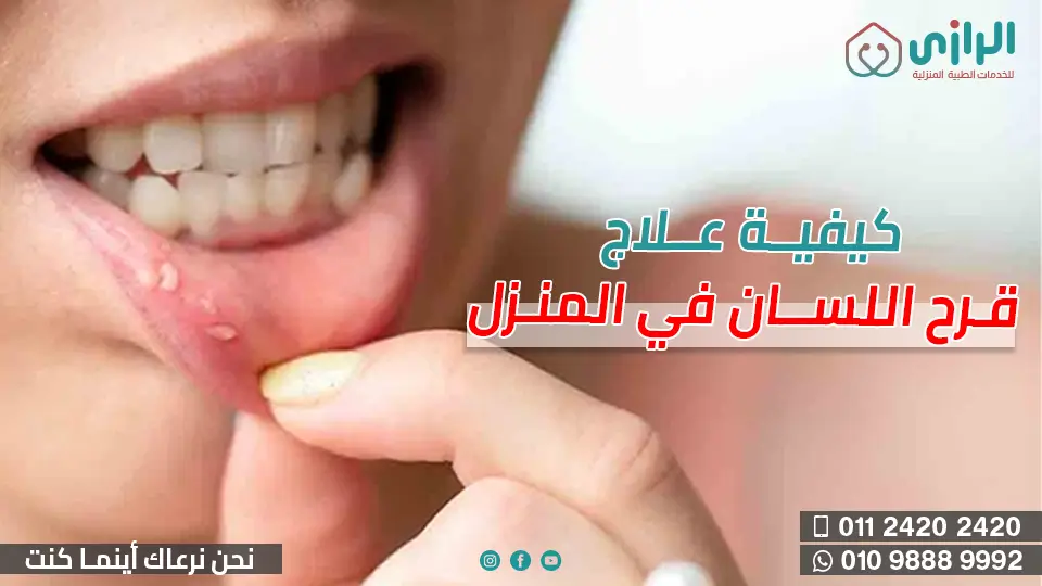 قرح-اللسان.webp