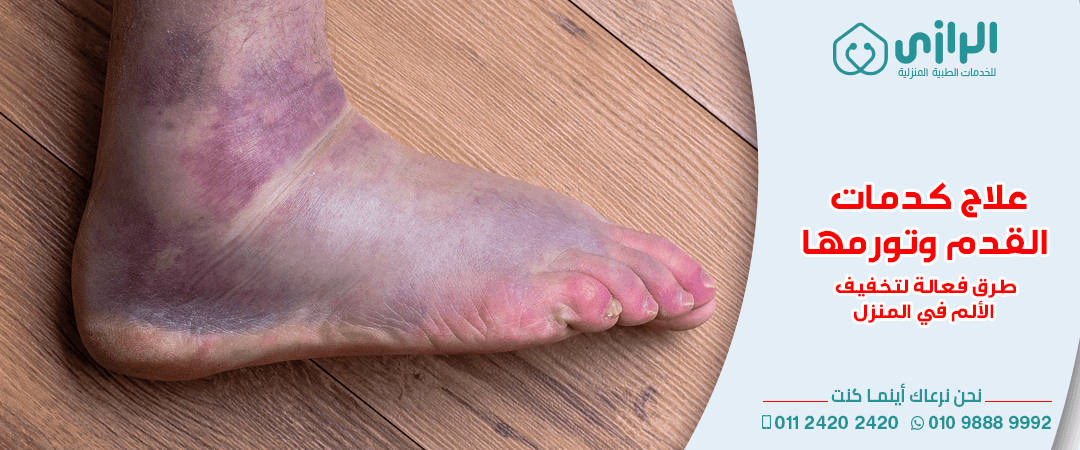 كدمات-القدم.png