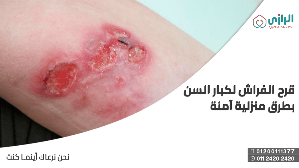 قرح-فراش.png