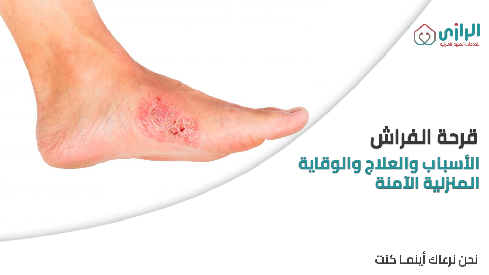 قرحة-فراش.png